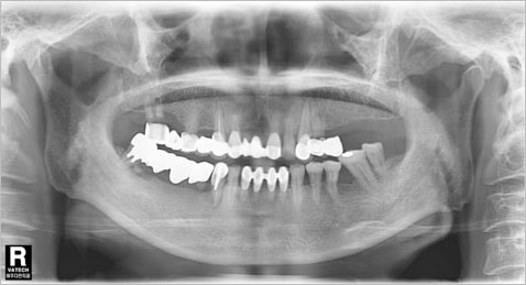 X-ray사진