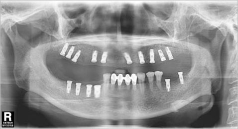 X-ray사진