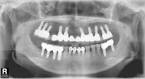 X-ray사진